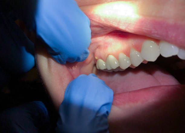 Best Emergency Dental Care for Sports Injuries in Bellville, OH